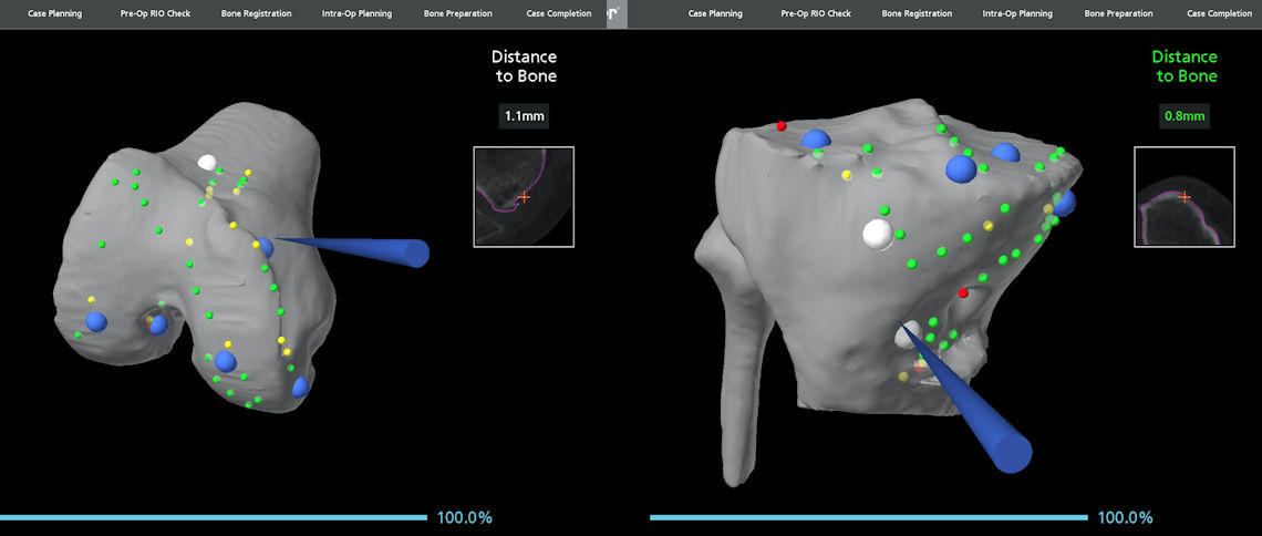 Figure 3: Registration of bone surfaces to the robot.