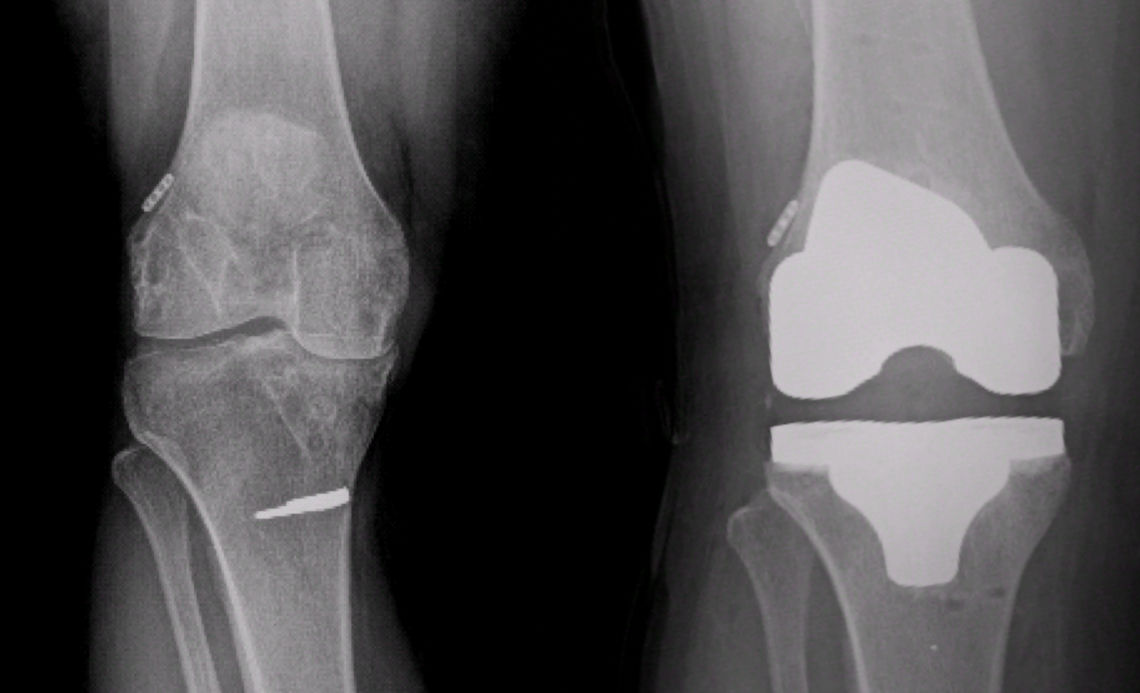 Figure 5: X-ray images of the knee of a patient with advanced arthritis before  and after robotic total knee replacement. 
