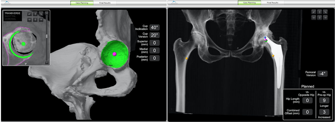 Figure 1 : Pre-operative planning of a robotic total hip replacement. 